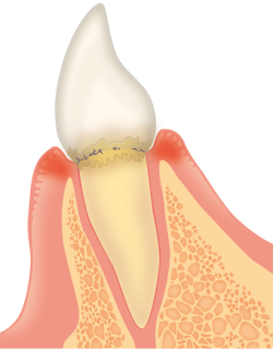 歯周病段階①