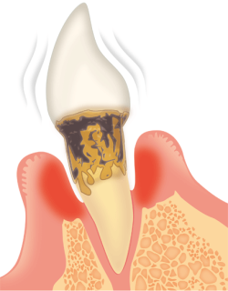 歯周病段階⓸