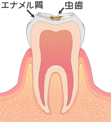 虫歯-C1
