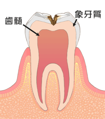 虫歯-C2