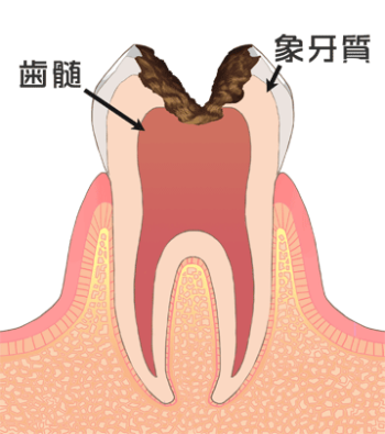 虫歯-C3